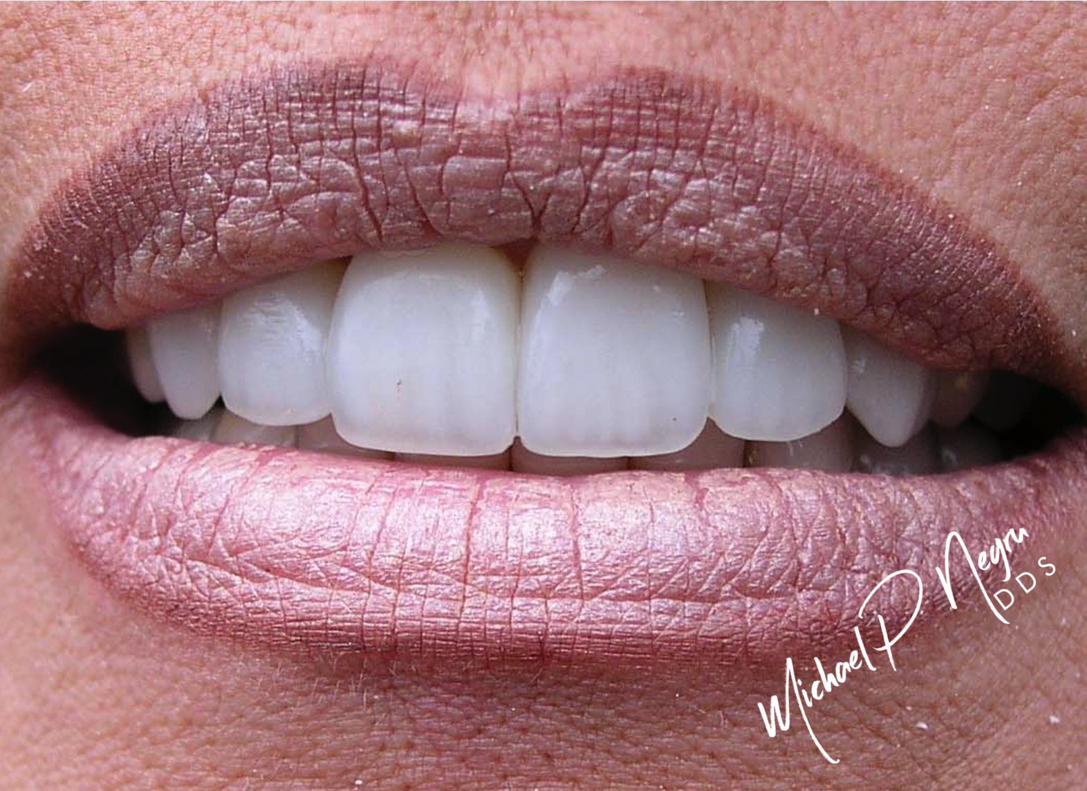 Anterior dental correction case with improved incisal edge position and smile frame
