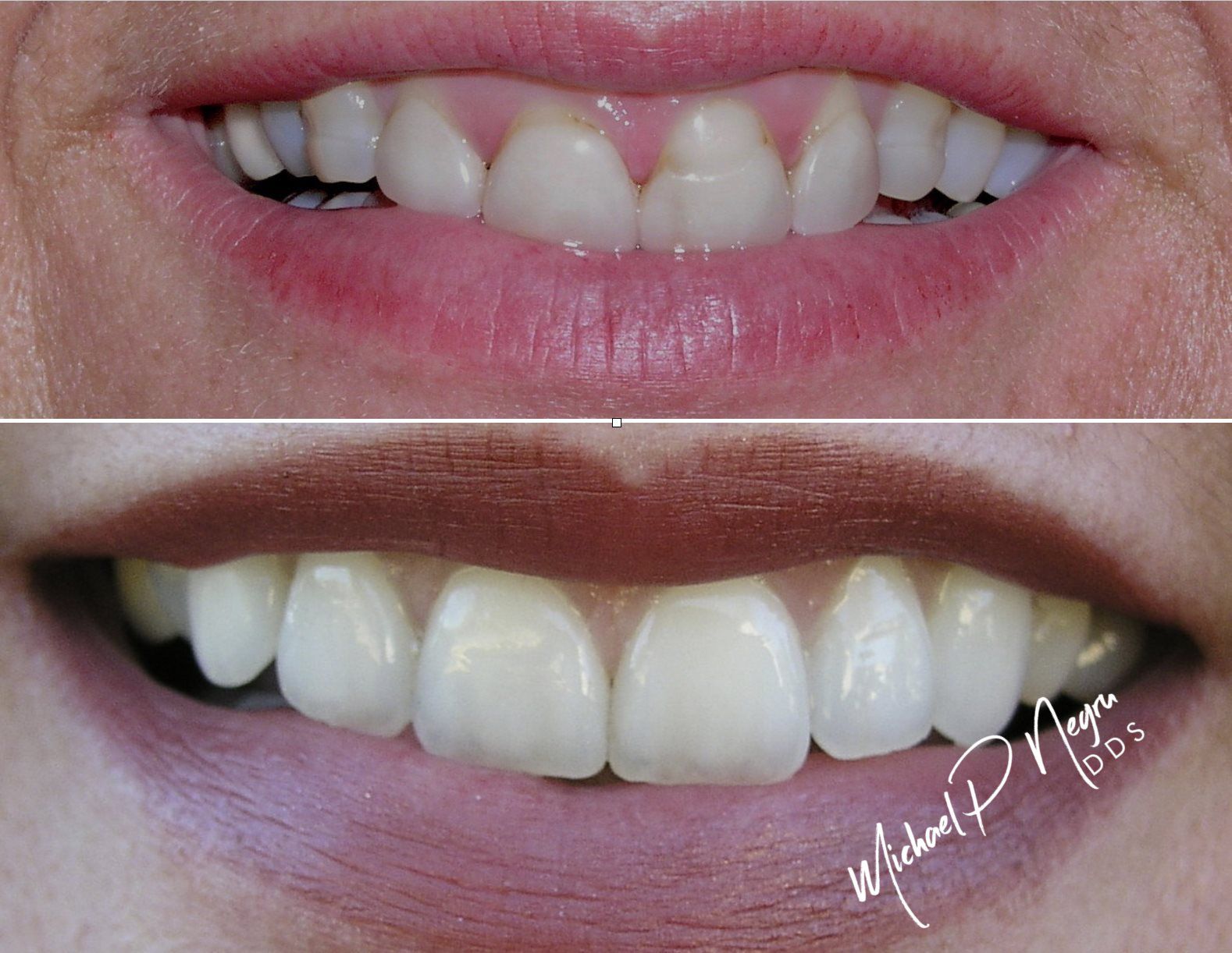 Close-up dental esthetic refinement showing natural tooth contours and translucency