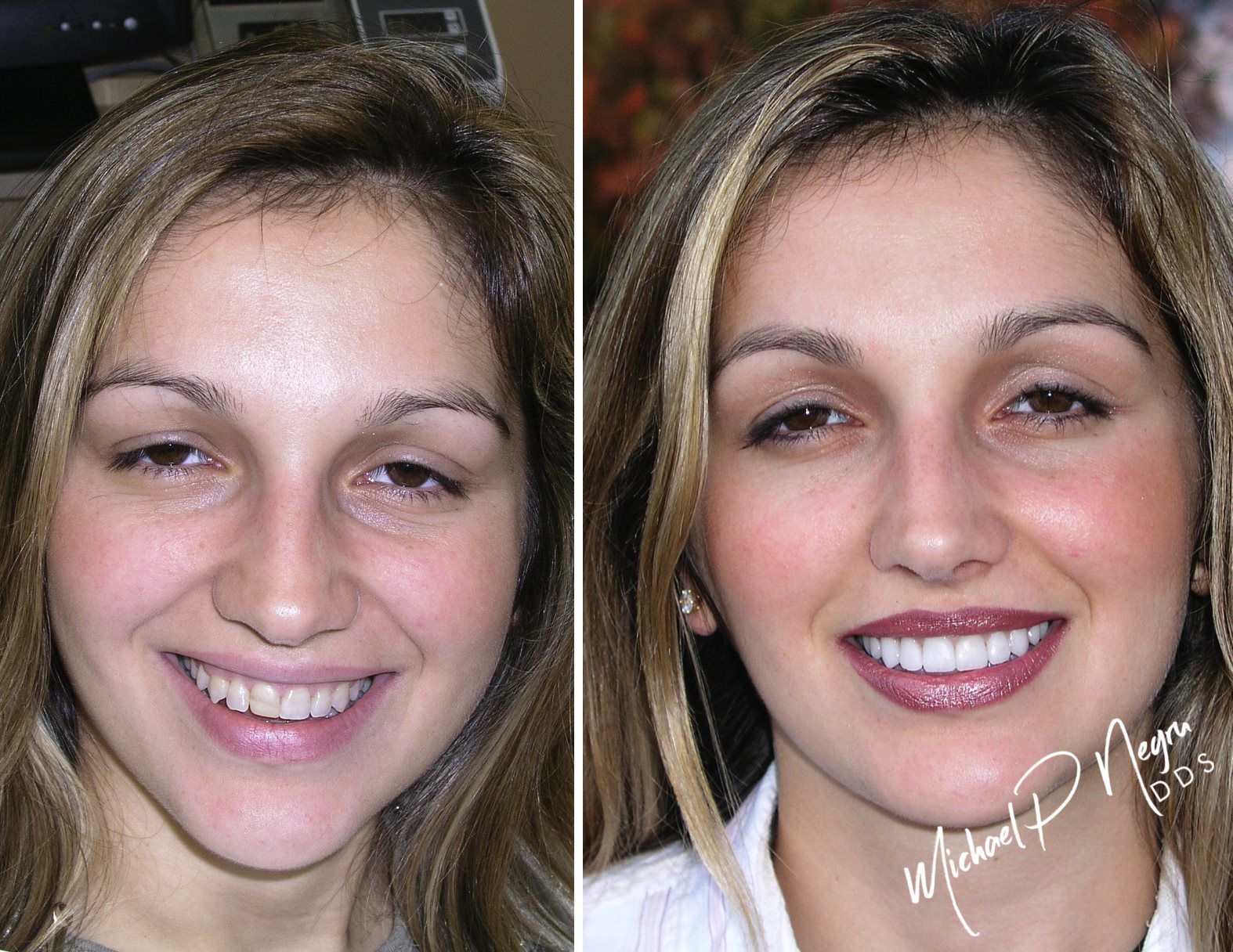 Natural smile enhancement case showing conservative esthetic improvement