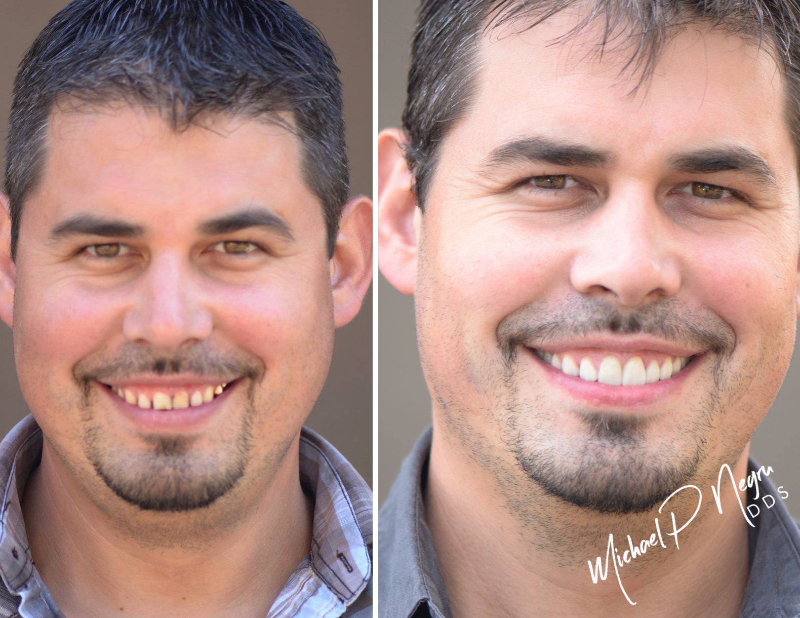 Male dental reconstruction case with durable functional restoration result